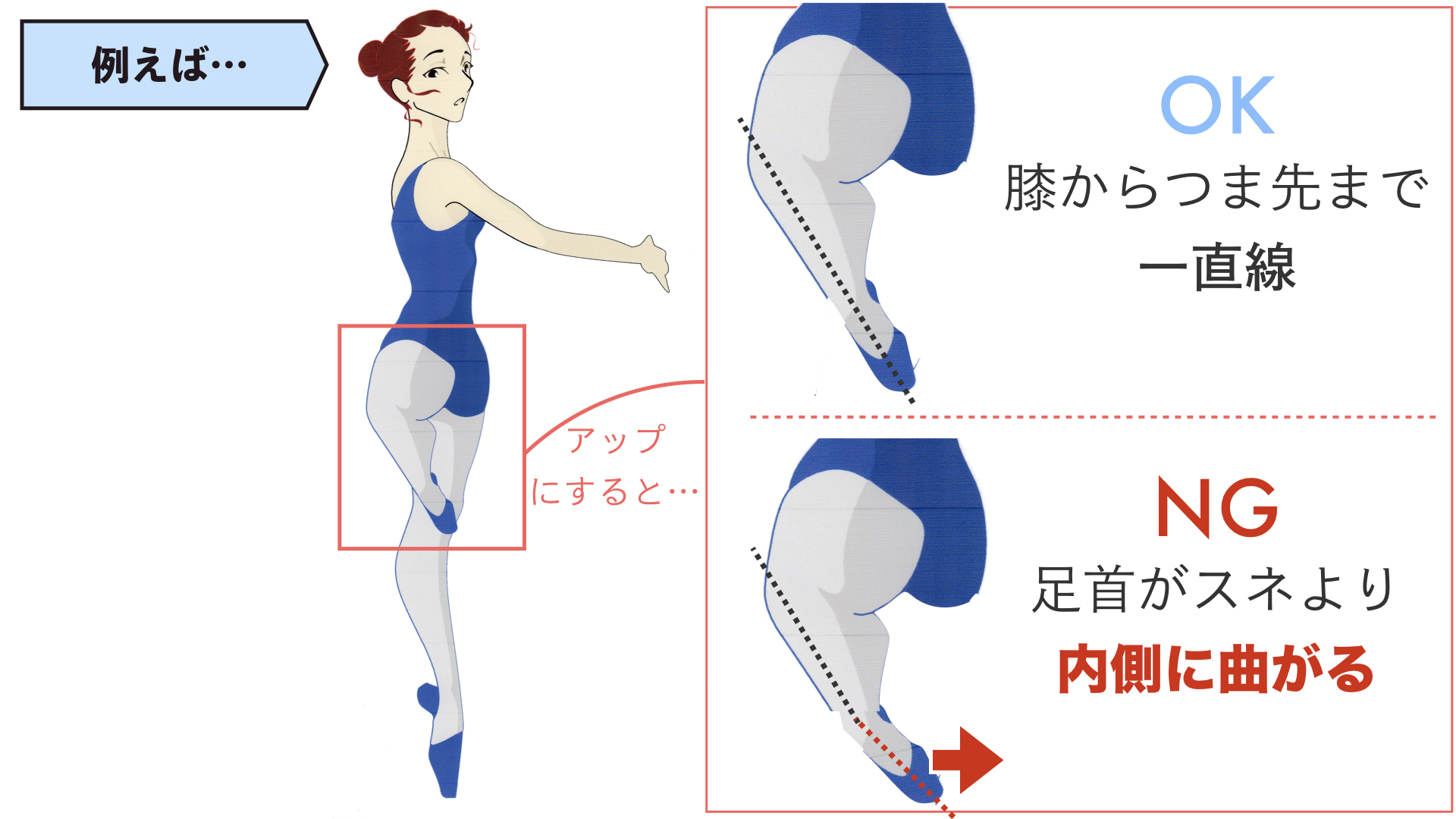 バレエの鎌足って 原因と直し方 バレエダンサーさんの治療院